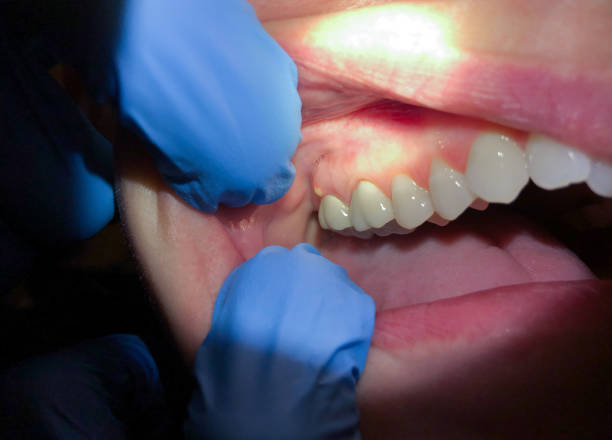 Best Dentist for Tooth Abscess  in Benton, AR